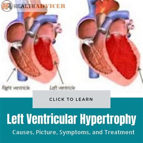 lvh symptoms and treatment